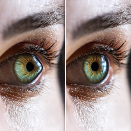 Eye Doctor Santa Ana CA Eye With Keratoconus